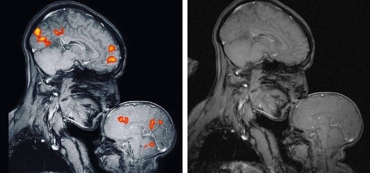 Görselin bir annenin bebeğini öptüğü sıradaki MR görüntüsü olduğu iddiası