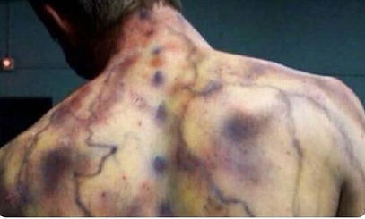 Fotoğrafın yıldırım çarpması sonucu insan bedeninin büründüğü hali gösterdiği iddiası