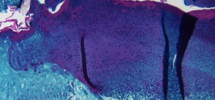 Meymunçiçəyinin Rusiyanın bioloji silahı olduğu iddiası