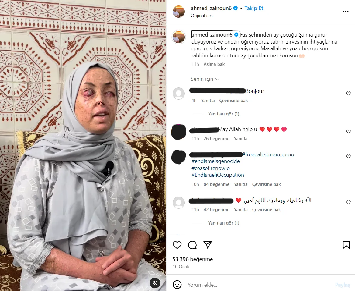 Xeroderma Pigmentosum Symptoms
